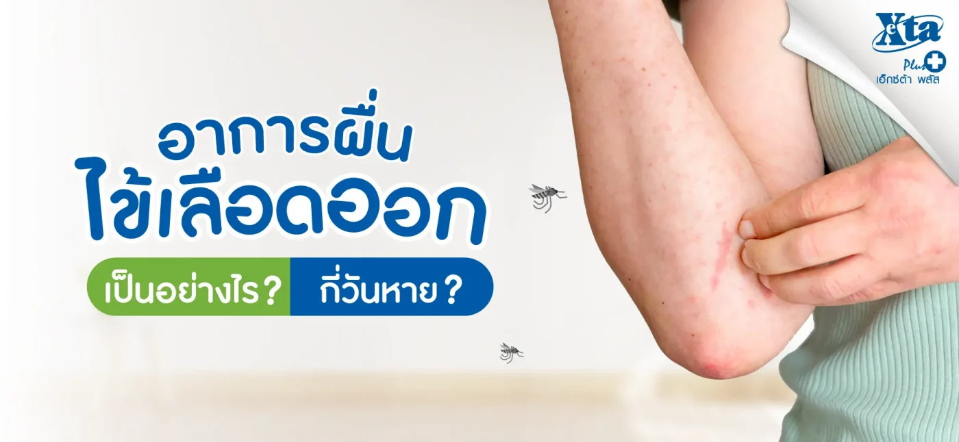 อาการผื่นไข้เลือดออก เป็นอย่างไร? กี่วันถึงจะหาย?