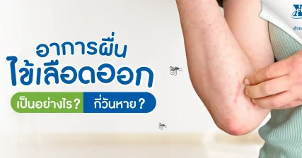 อาการผื่นไข้เลือดออก เป็นอย่างไร? กี่วันถึงจะหาย?