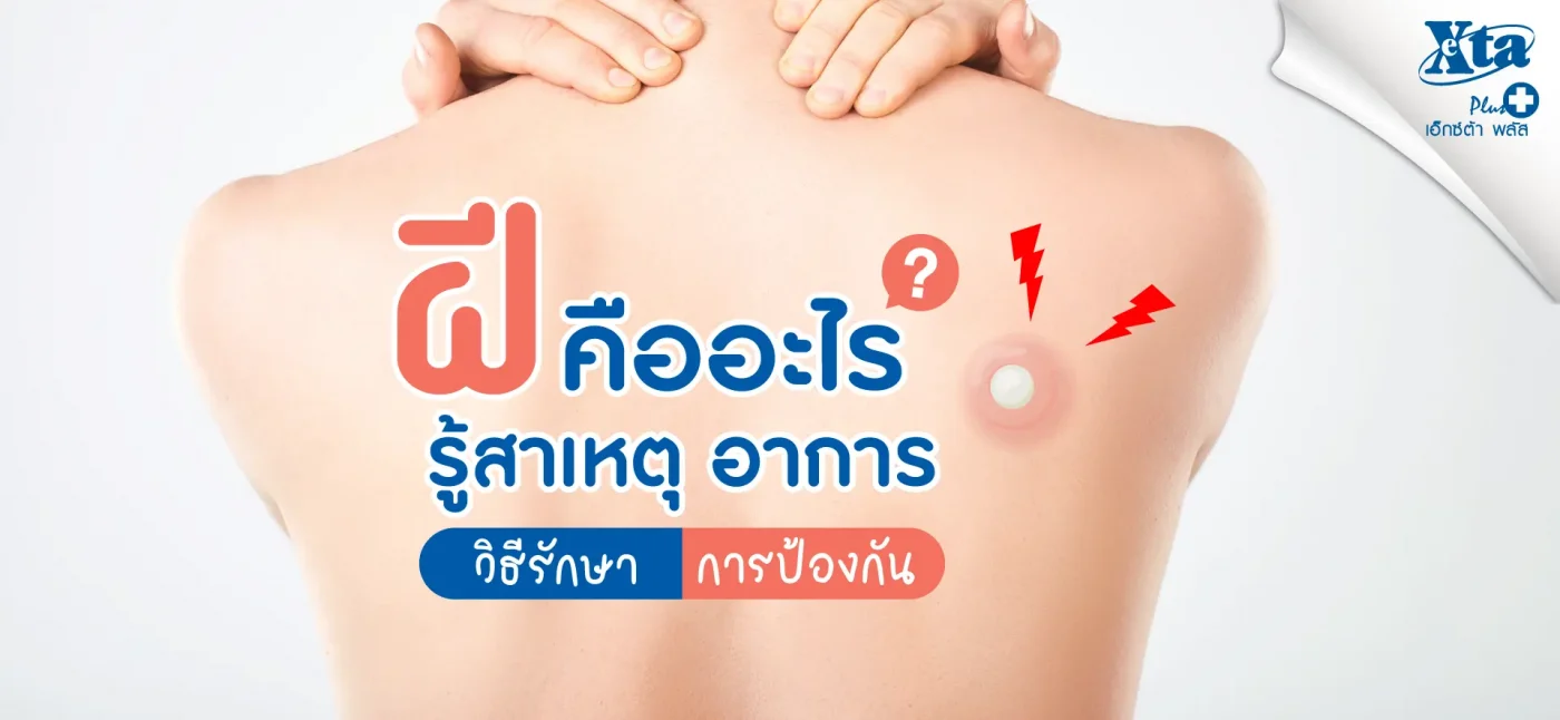 ฝี คืออะไร? รู้สาเหตุ อาการ วิธีรักษา และการป้องกันด้วยตัวเอง