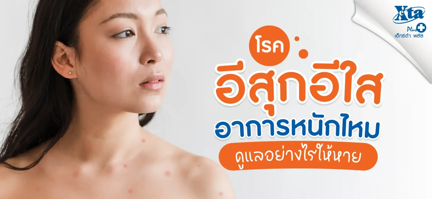 โรคอีสุกอีใส (Chickenpox) อาการหนักไหม ? ดูแลอย่างไรให้หาย