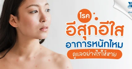 โรคอีสุกอีใส (Chickenpox) อาการหนักไหม ? ดูแลอย่างไรให้หาย