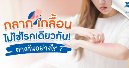 ไขข้อเข้าใจผิด! กลาก เกลื้อน ไม่ใช่โรคเดียวกัน ต่างกันอย่างไร